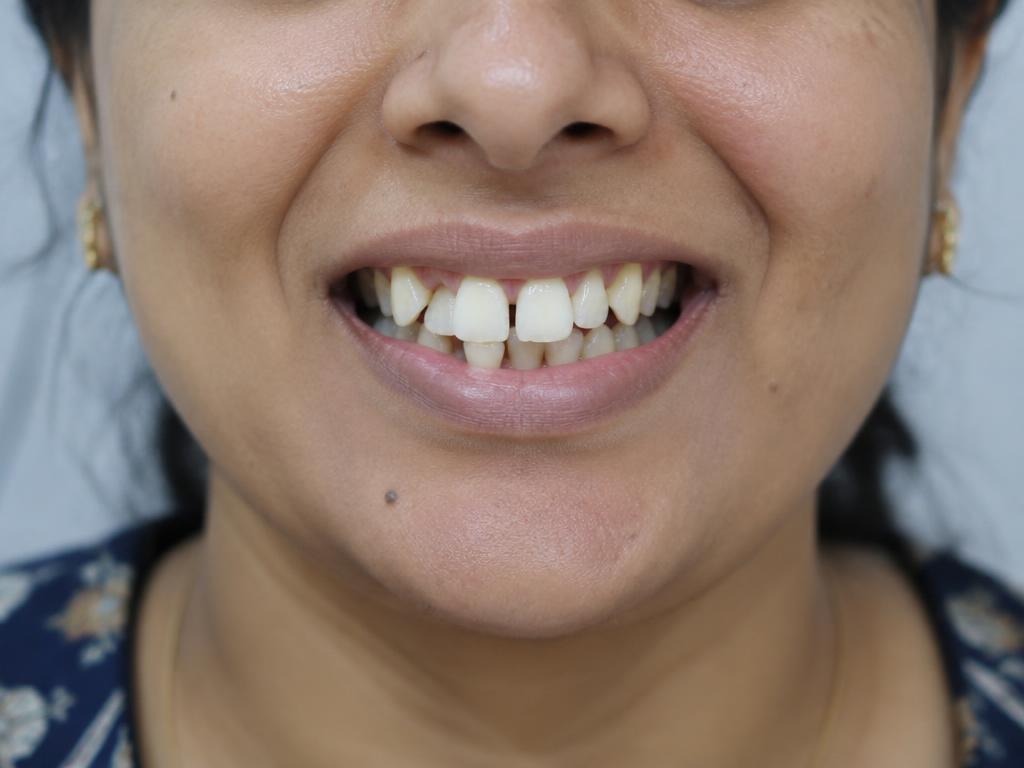 Smile Makeover — before treatment